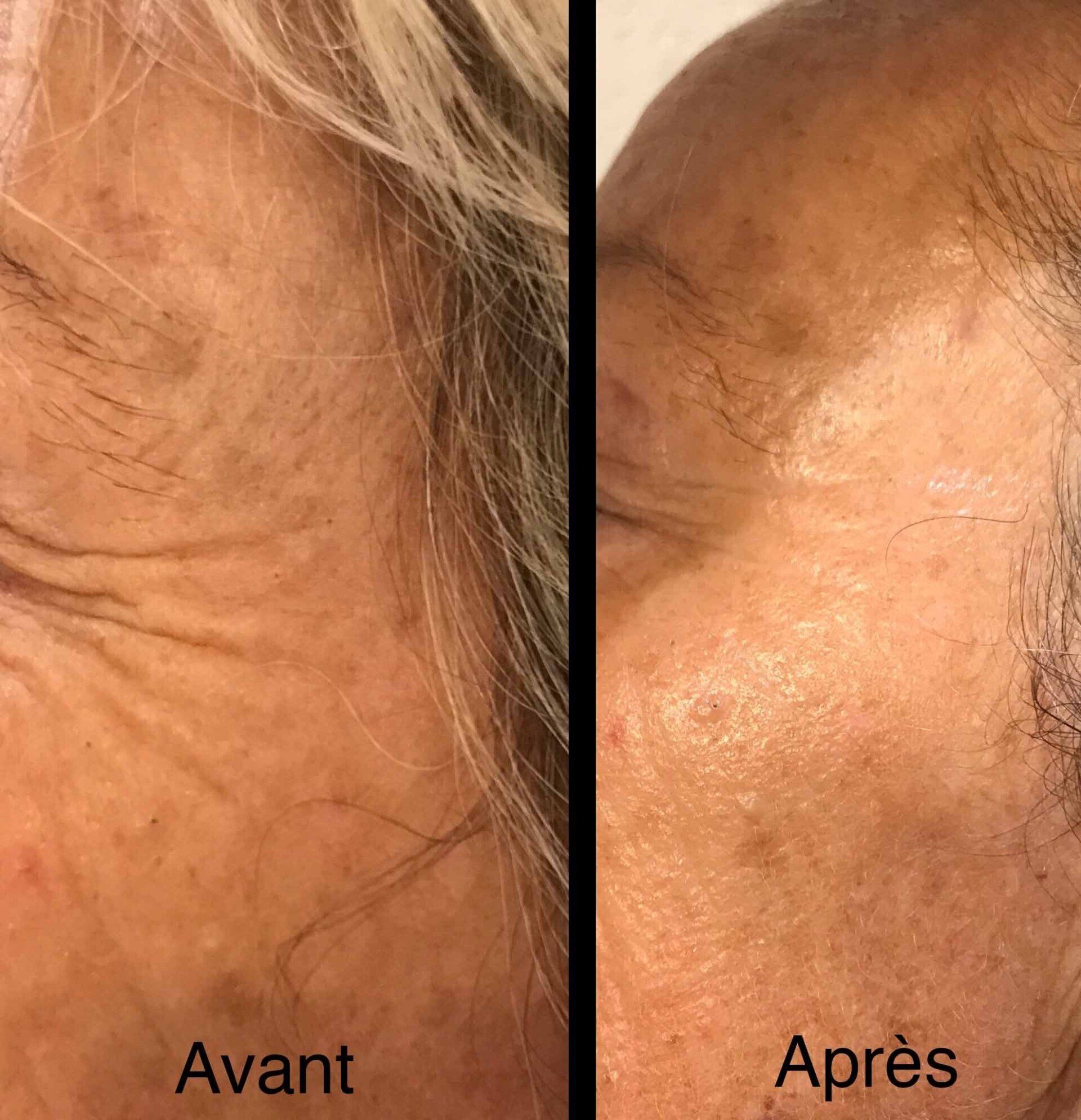 Photo avant/après pour soins cavitation du visage