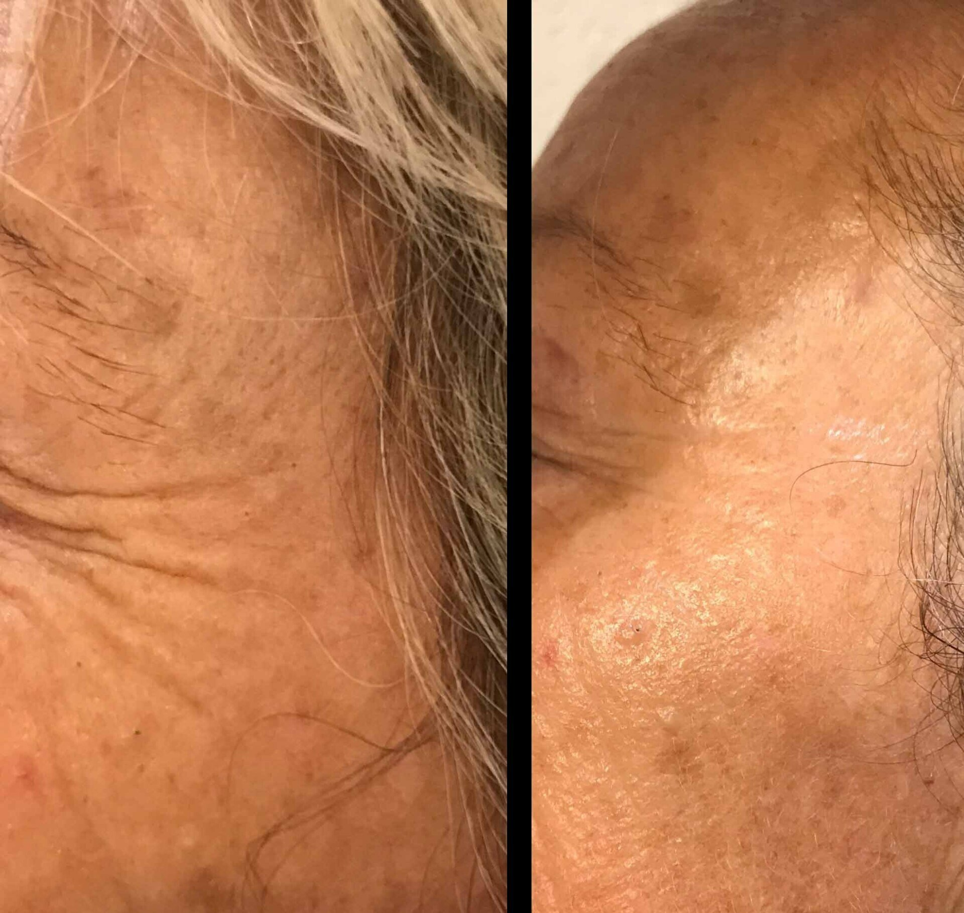 Jet peel avant après rides oeil