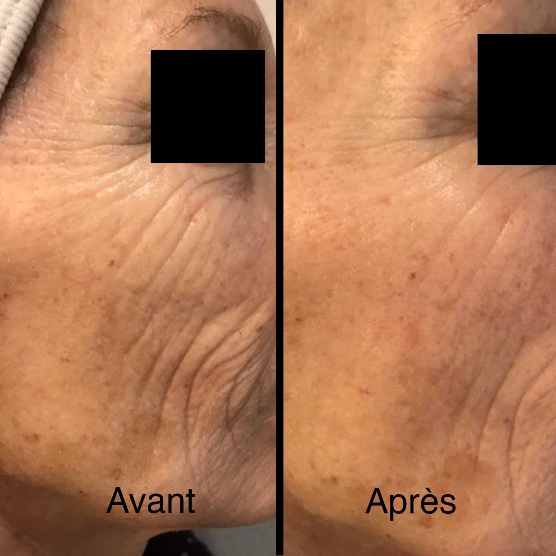 Photo avant/après pour soin LED