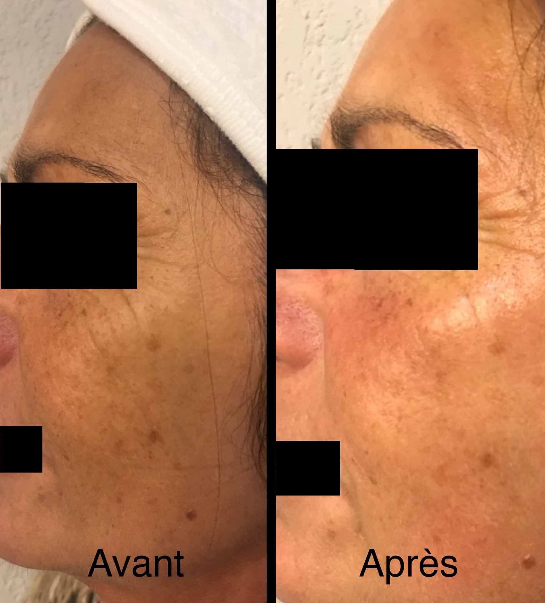 Photo avant/après pour soin du visage avec luminothérapie