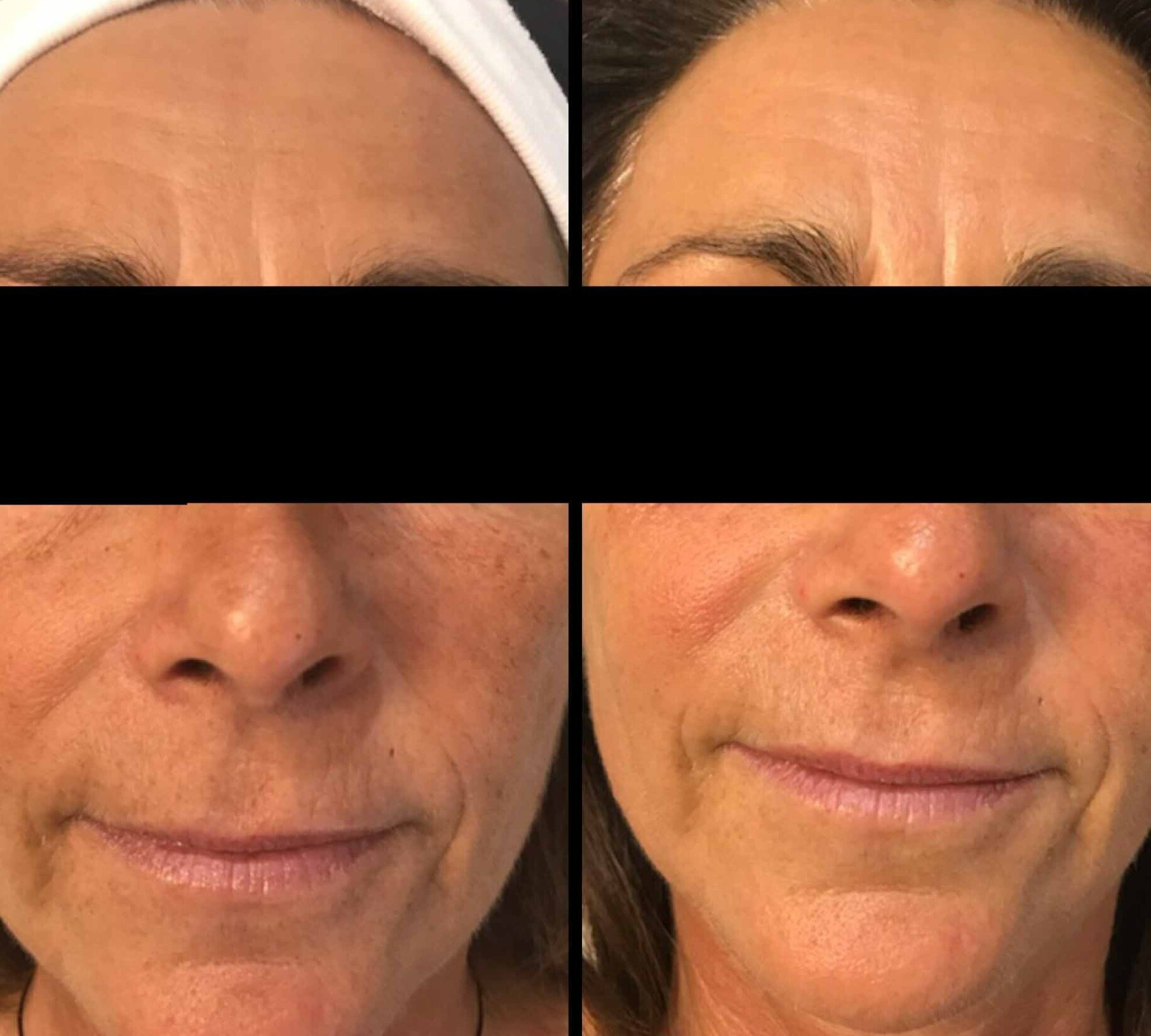 Jet peel avant après rides bouches