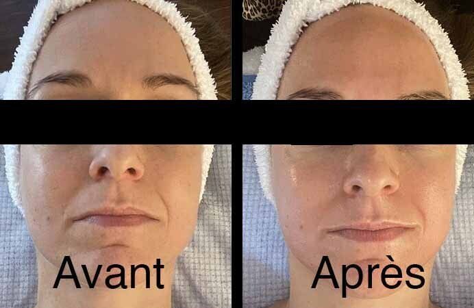 Photo avant/après pour soin Jetpeel du visage