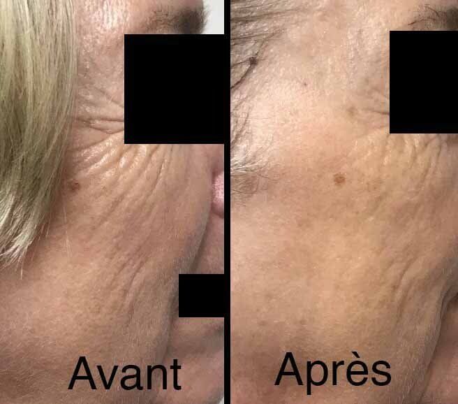 Photo avant/après pour soin peeling du visage