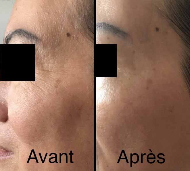 Photo avant/après pour soin anti-âge au niveau des yeux