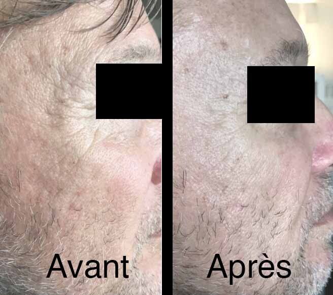 Photo avant/après pour soins antitaches au niveau des pommettes