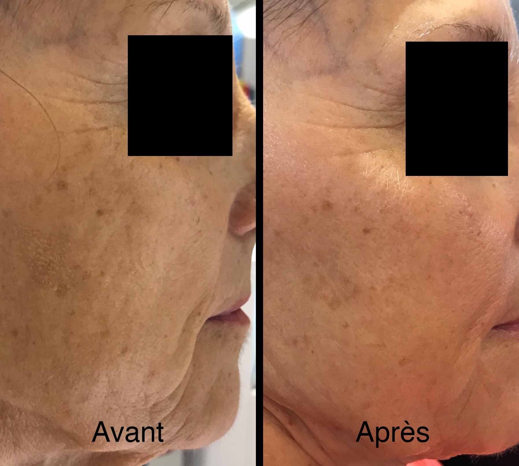 Photo avant/après pour soins antitaches au niveau du visage