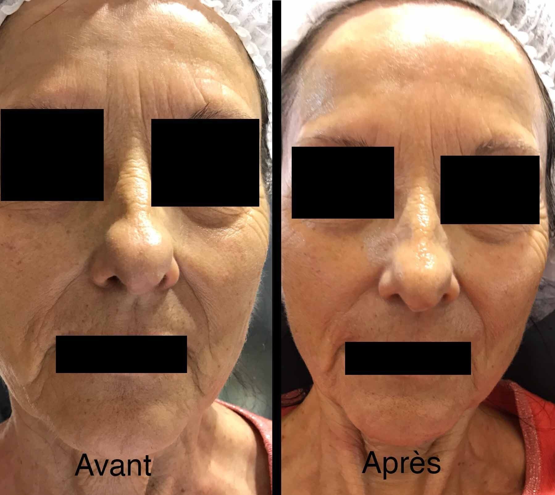 Photo avant/après soin anti-âge visage