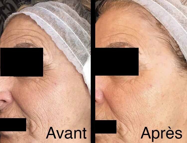 Photo avant/après pour soin antirides au niveau des yeux