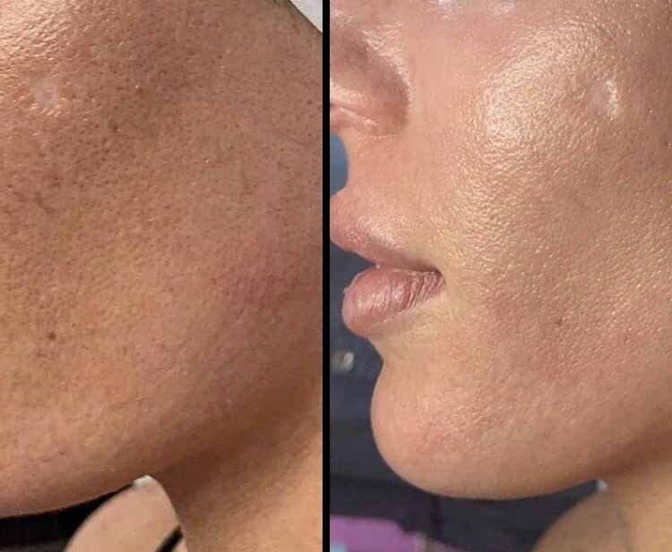 Grain de peau amélioré visage