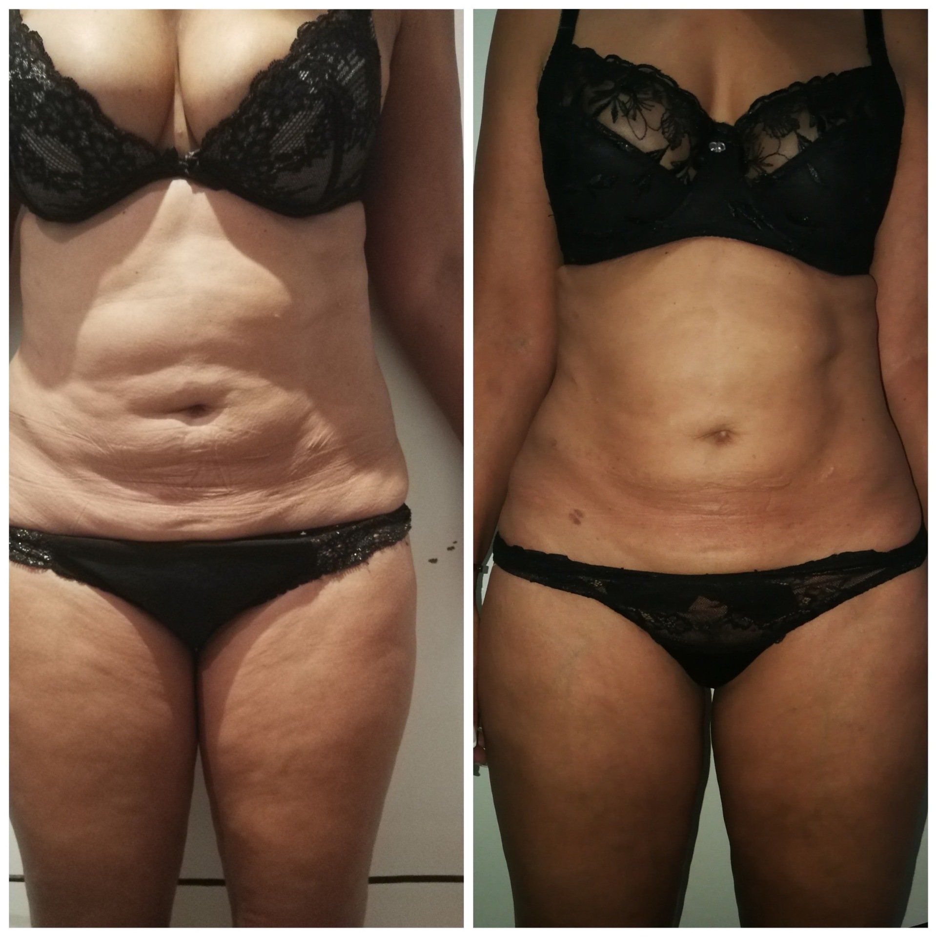 Perte d'amas graisseux ventre