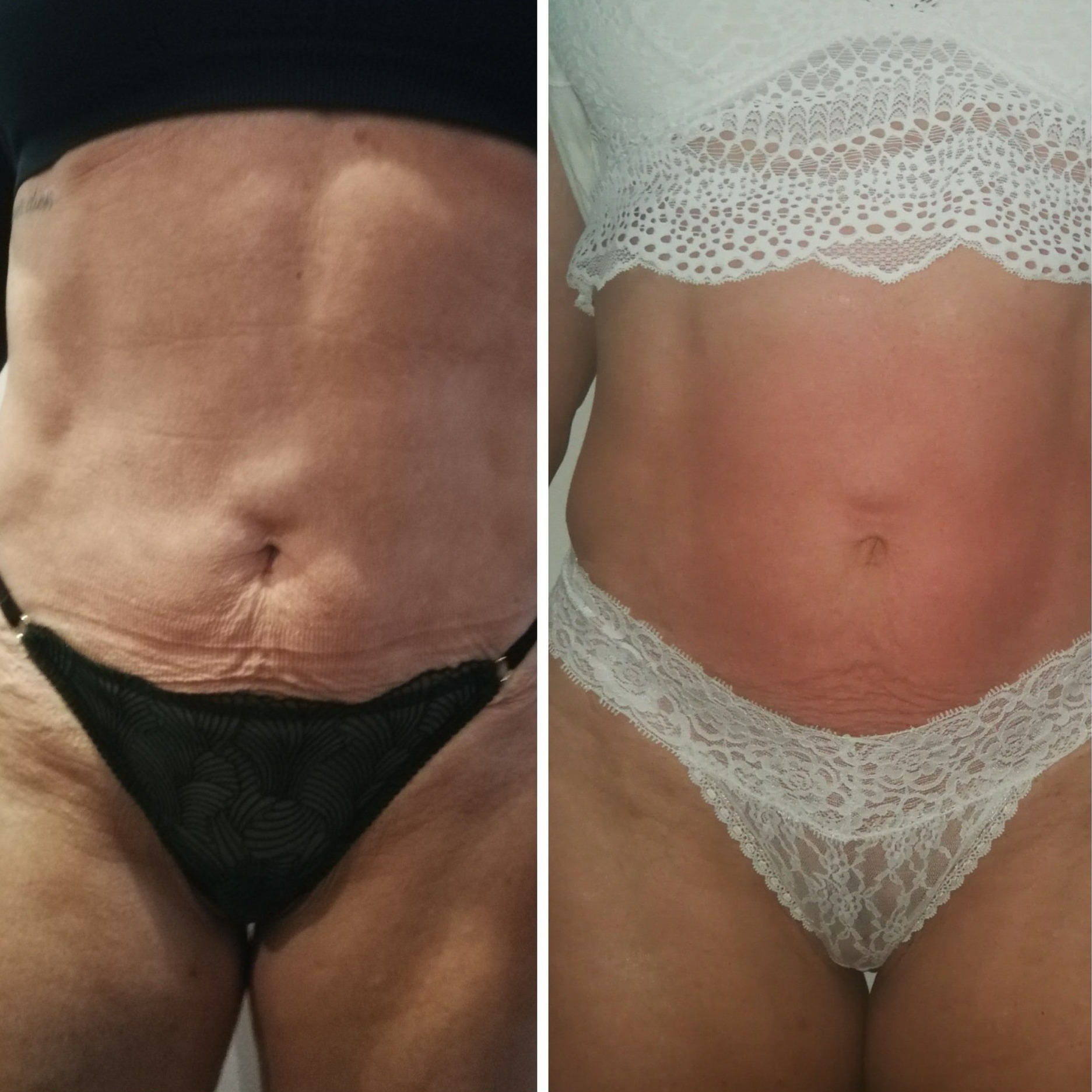 Radiofréquence avant après