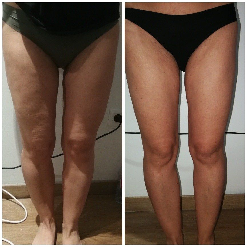 Peau raffermie cuisses