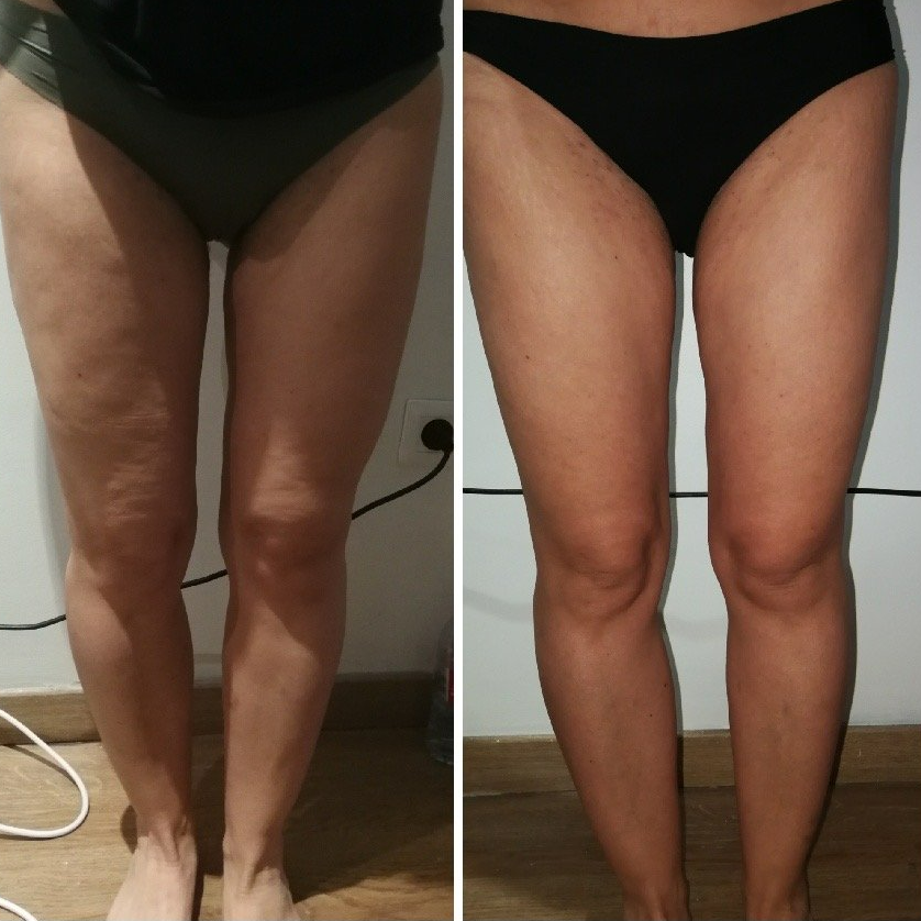 Twin slim avant après