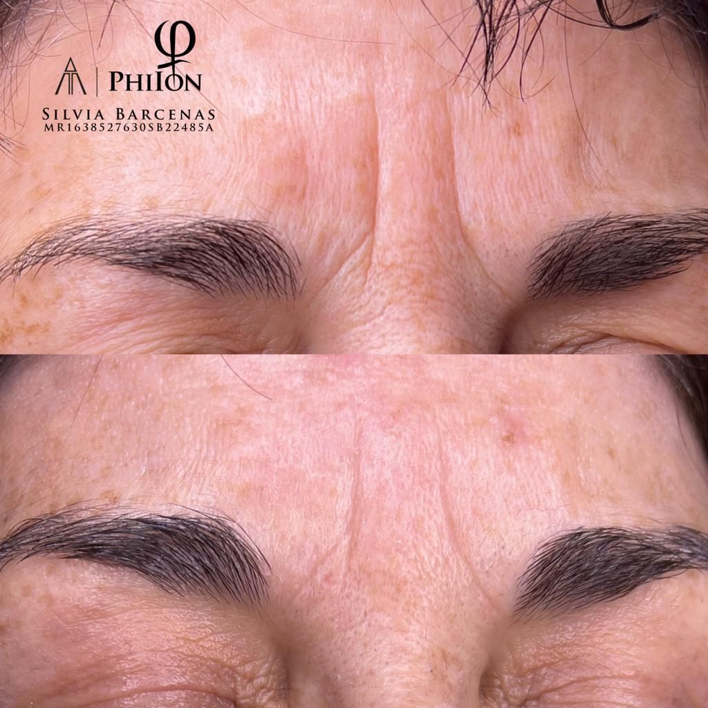 Comparación de la frente de una mujer antes y después de la micropigmentación de cejas; arrugas visibles, cejas oscuras.