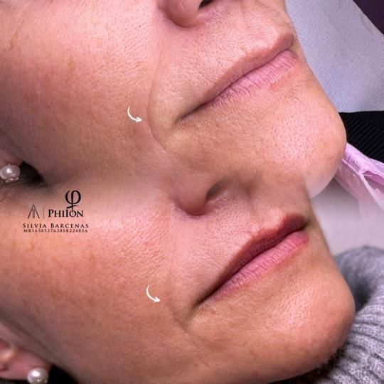 Fotografías de antes y después de la parte inferior del rostro de una persona, que muestran disminución de arrugas y aumento de labios.