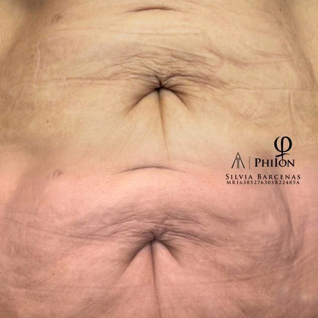 Comparación de un ombligo antes y después de un procedimiento cosmético, mostrando un cambio en la apariencia.