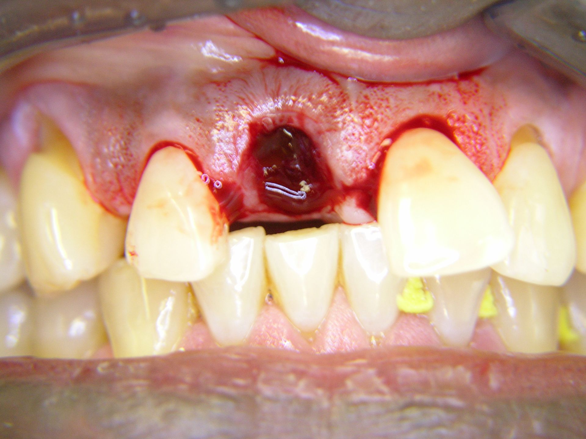 1.Status nach Entfernung gebrochenem Zahnfragment
