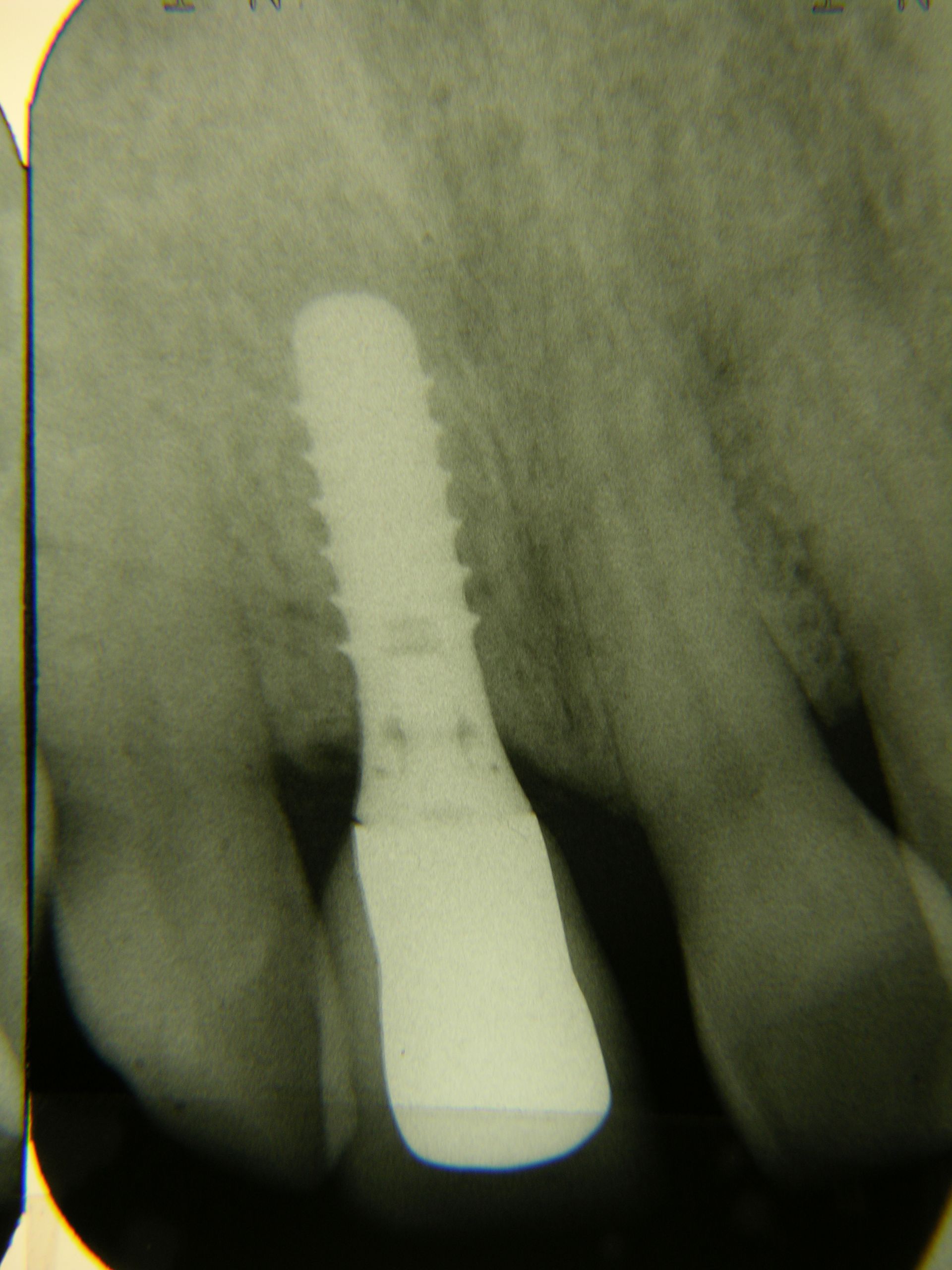 11. 11 Implantat mit Krone