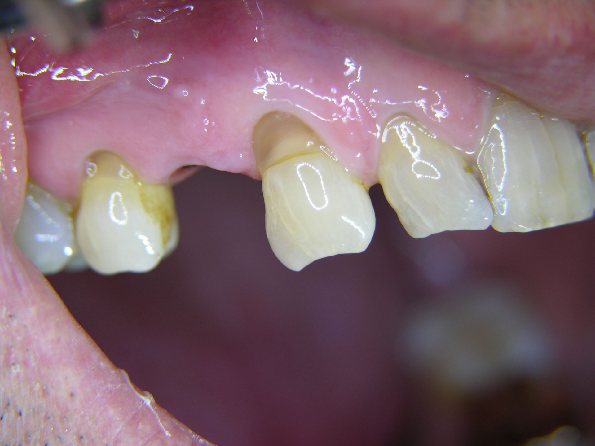 1 Lücke nach Eckzahn