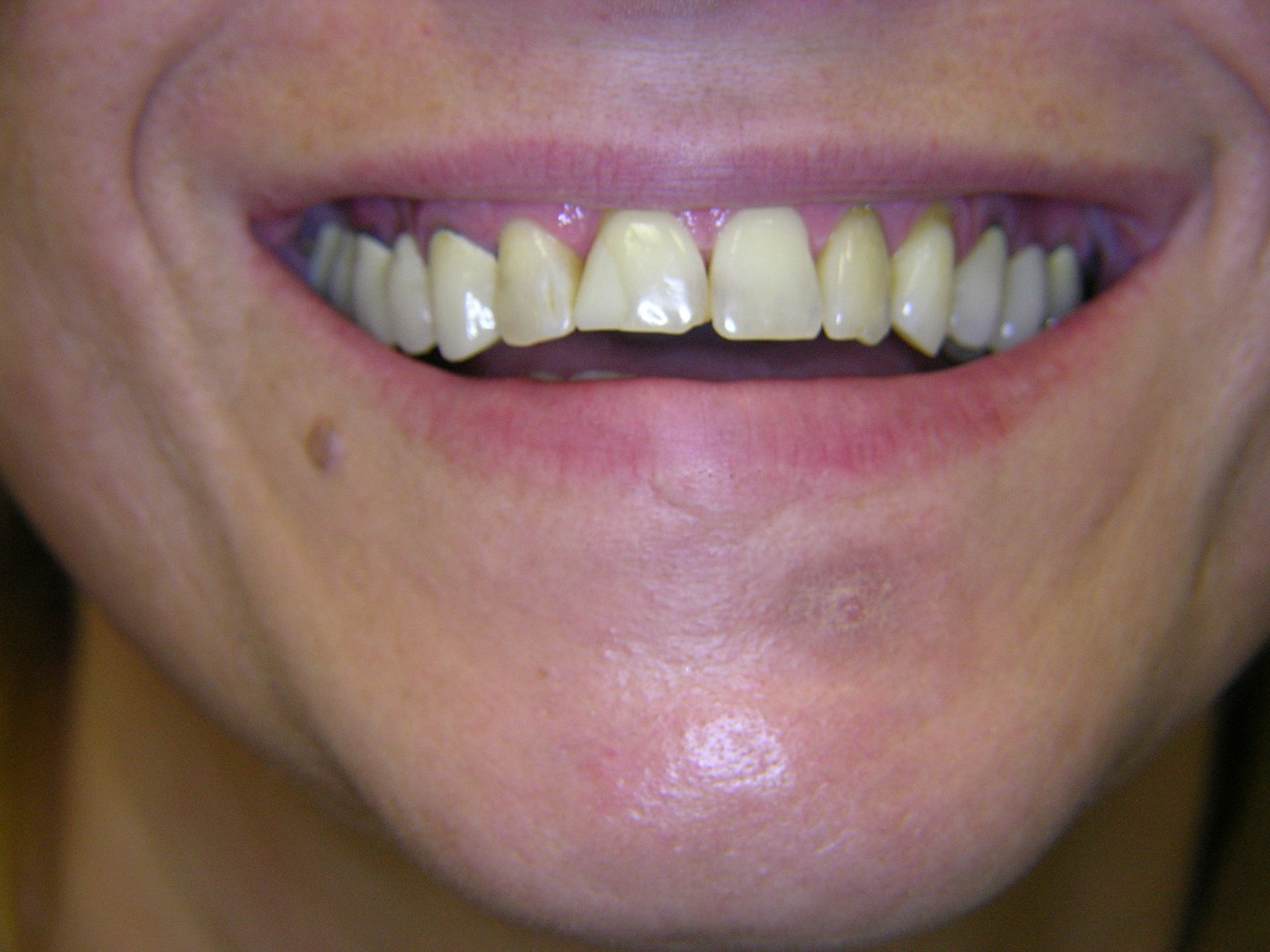 1 Patient mit unschöner Lachlinie und verlorenen Brücken rechts und links