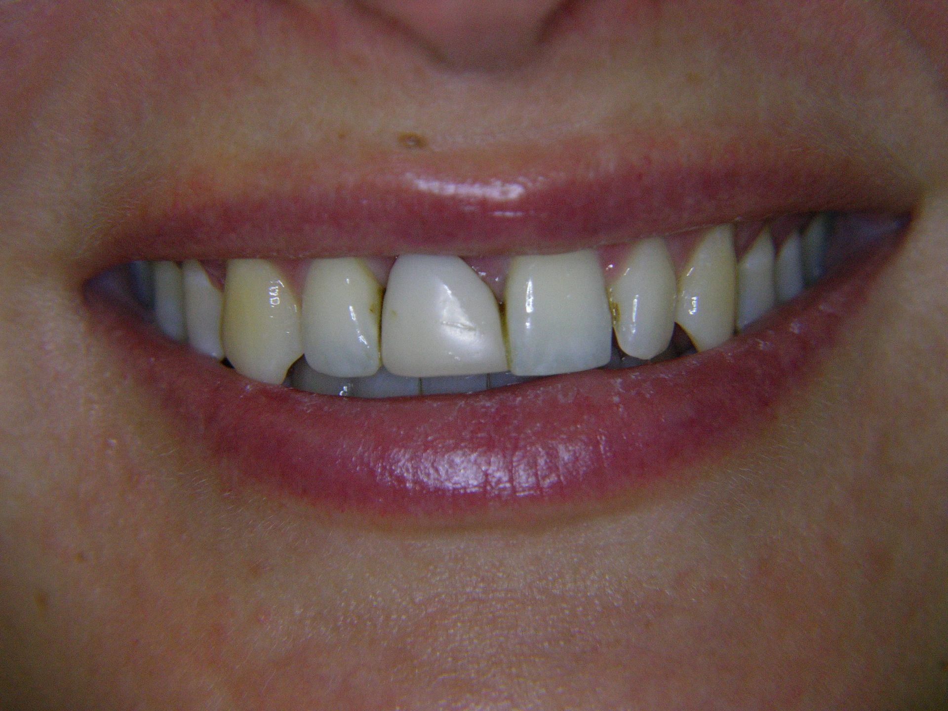 1  Unschöne Klebebrücke rechter Frontzahn