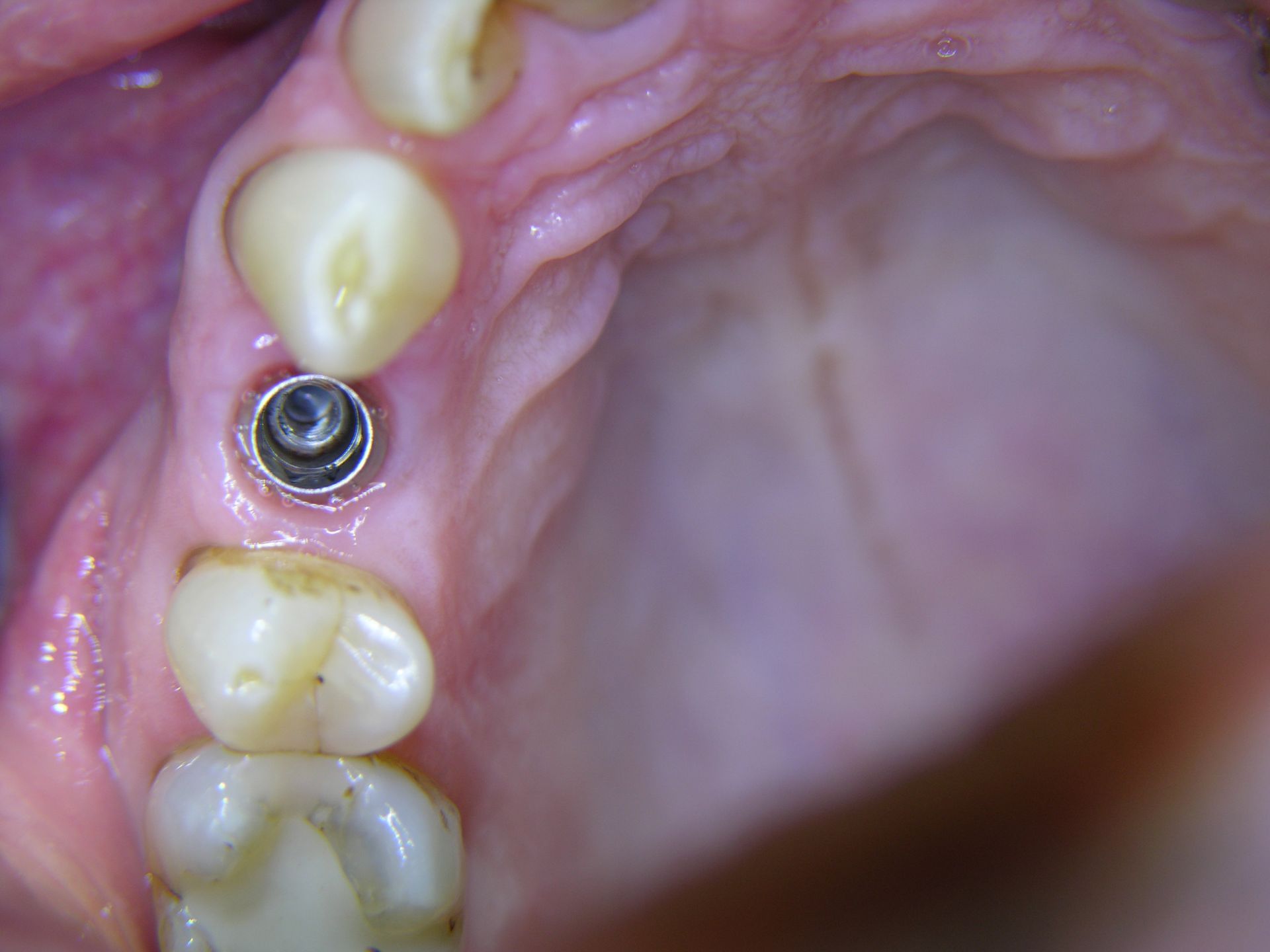 2 Implantat in Lücke eingesetzt