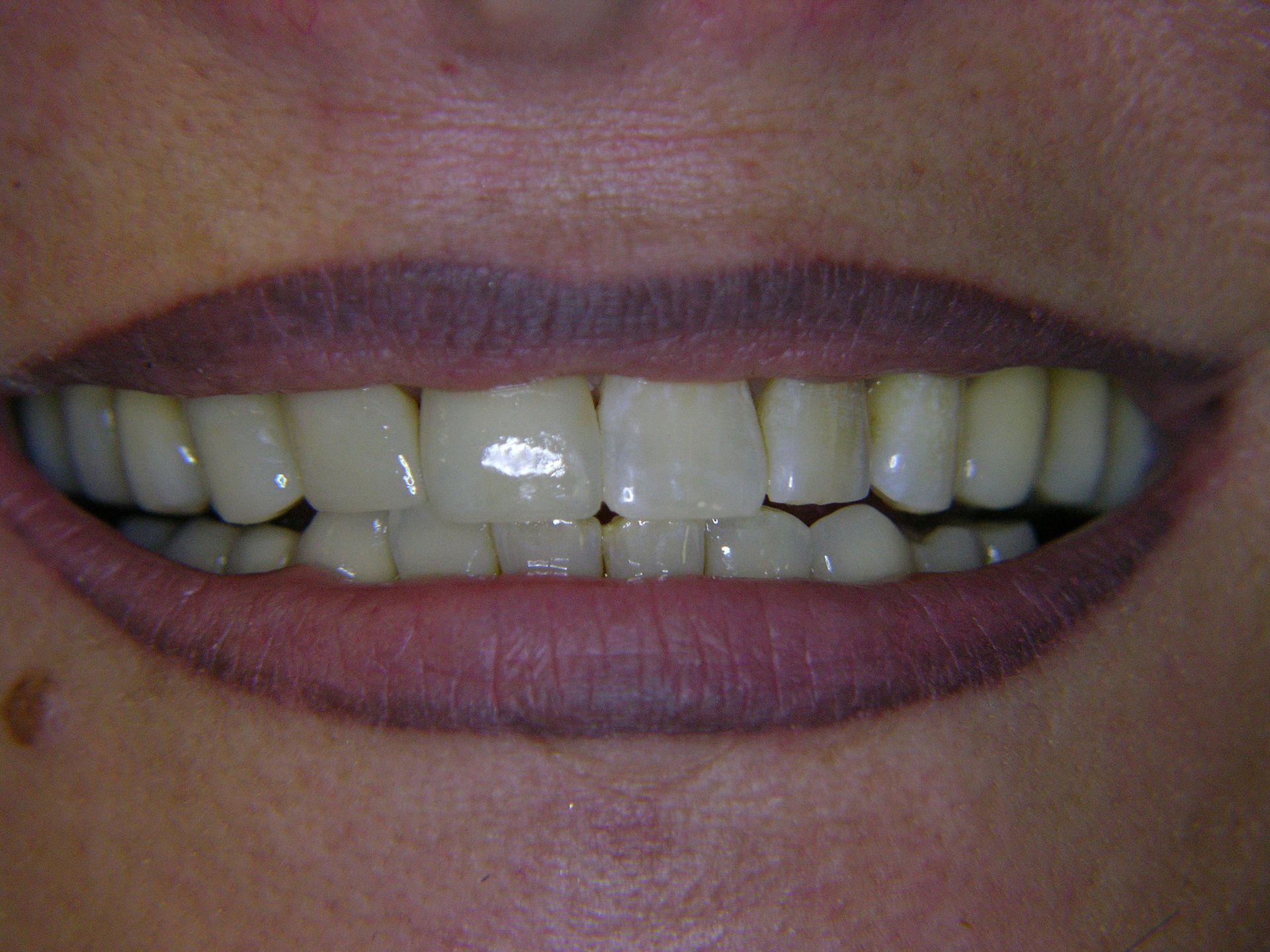 2 Nach Abschluss der Behandlung mit Implantatbrücke rechts und neuen Kronen und Veneers vorne und links