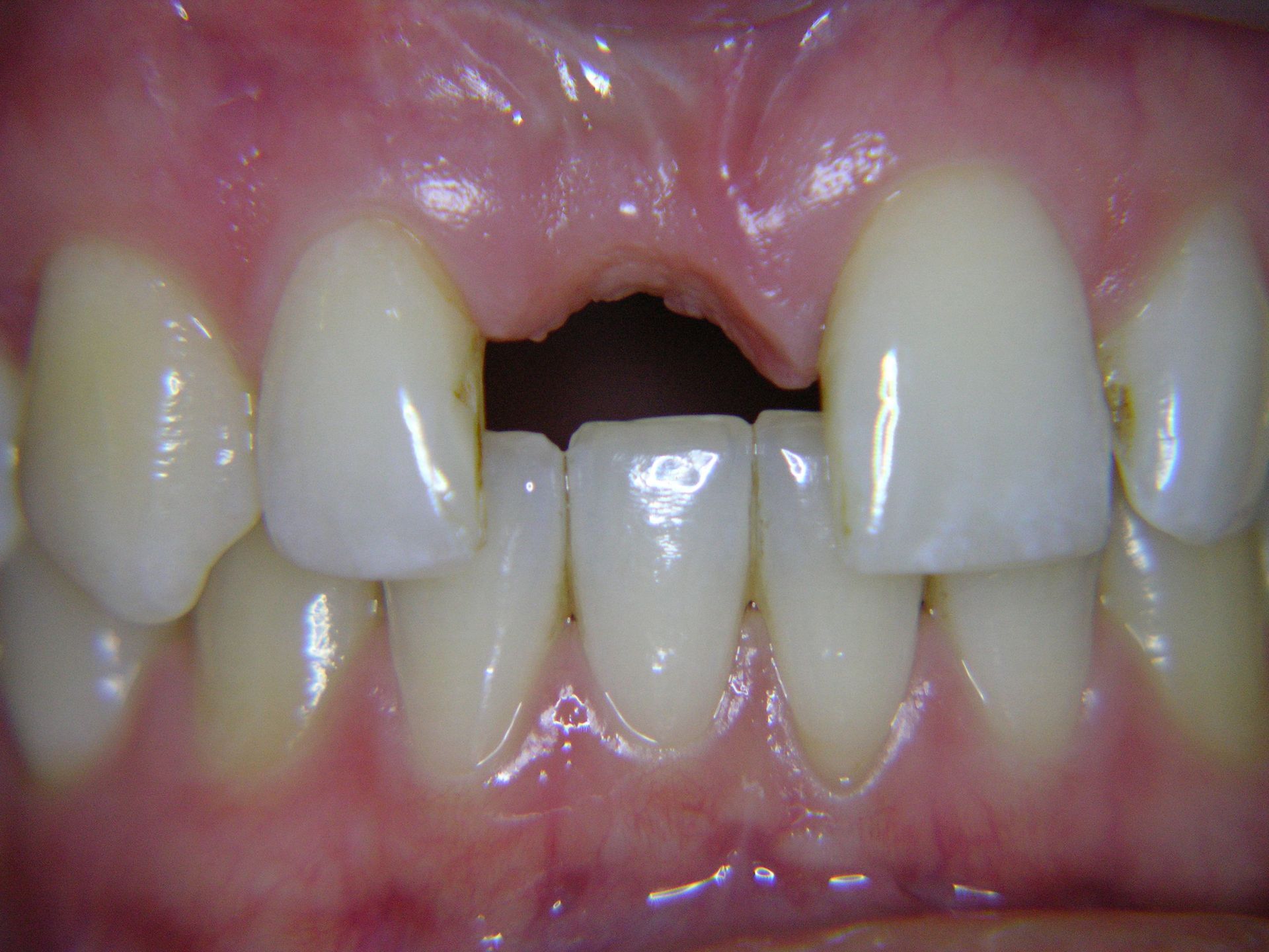 2 nach Entfernung Klebebrücke