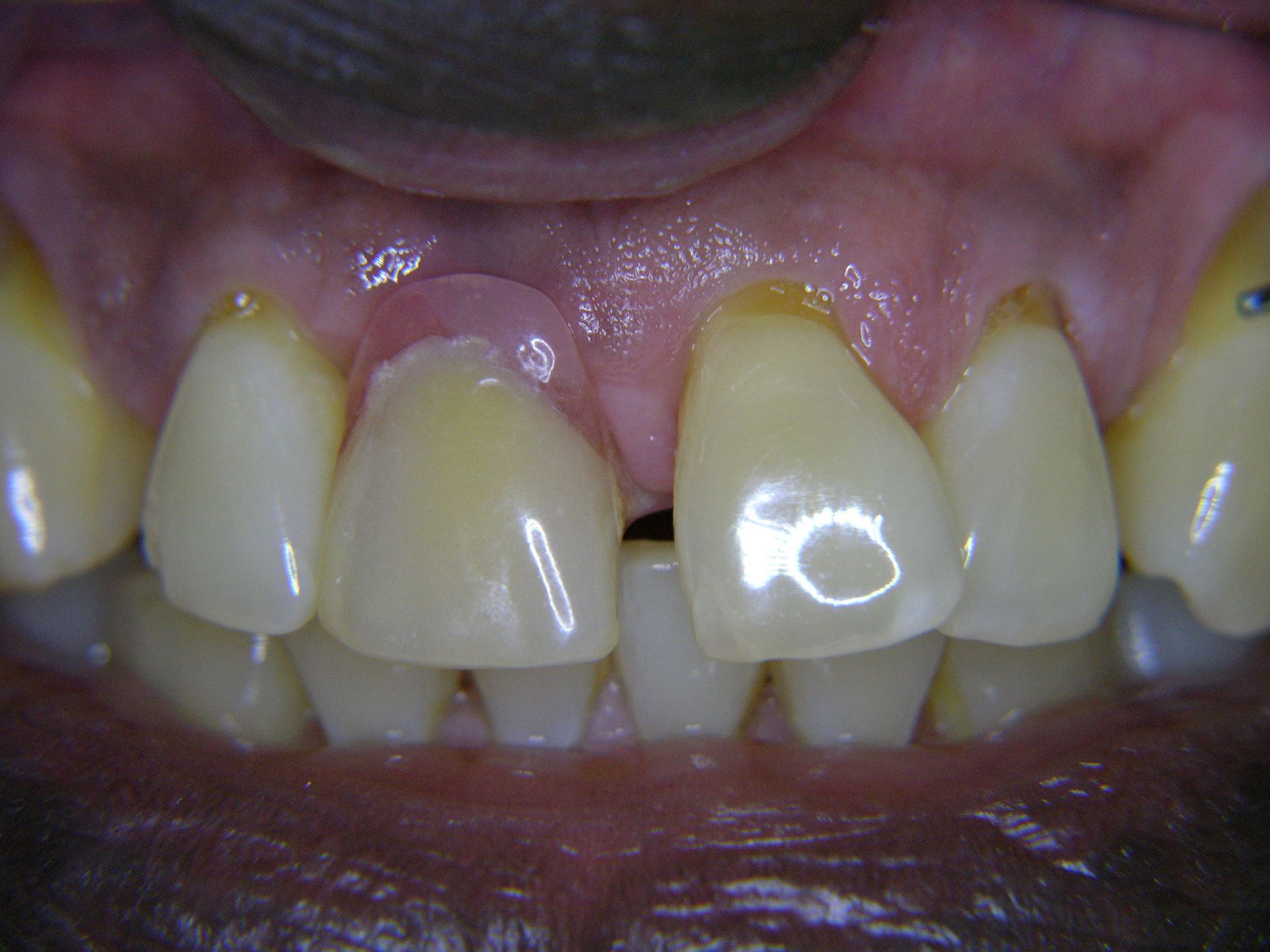 3. Ansicht im Mund mit Prothese