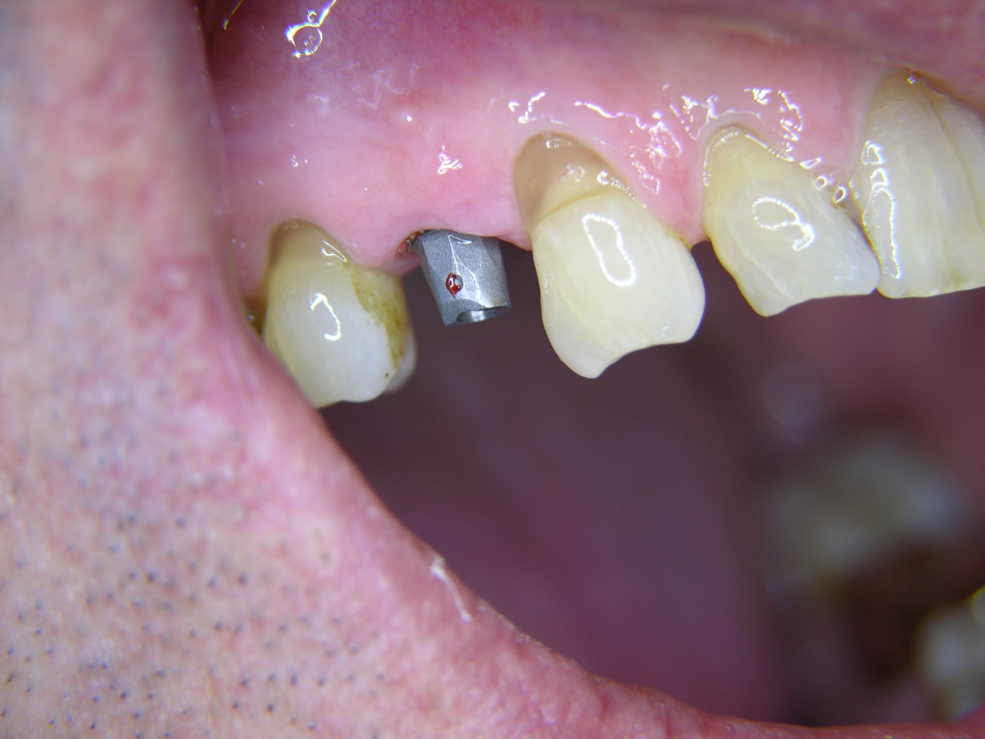 3 Abutment im Implantat auf das die Krone aufgesetzt wird