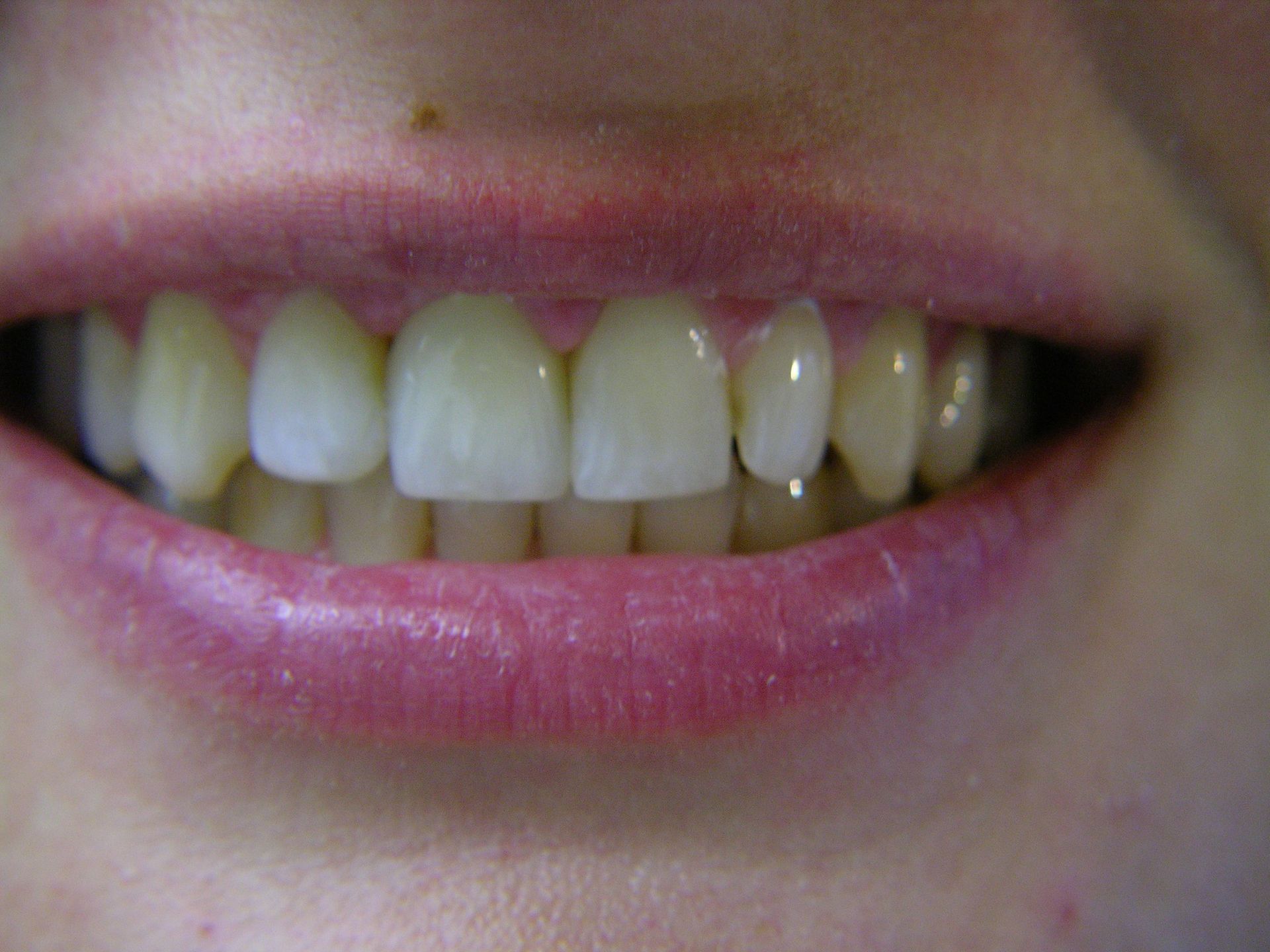 3 nach Neuversorgung mit Kieferkammaufbau und Implantatkrone