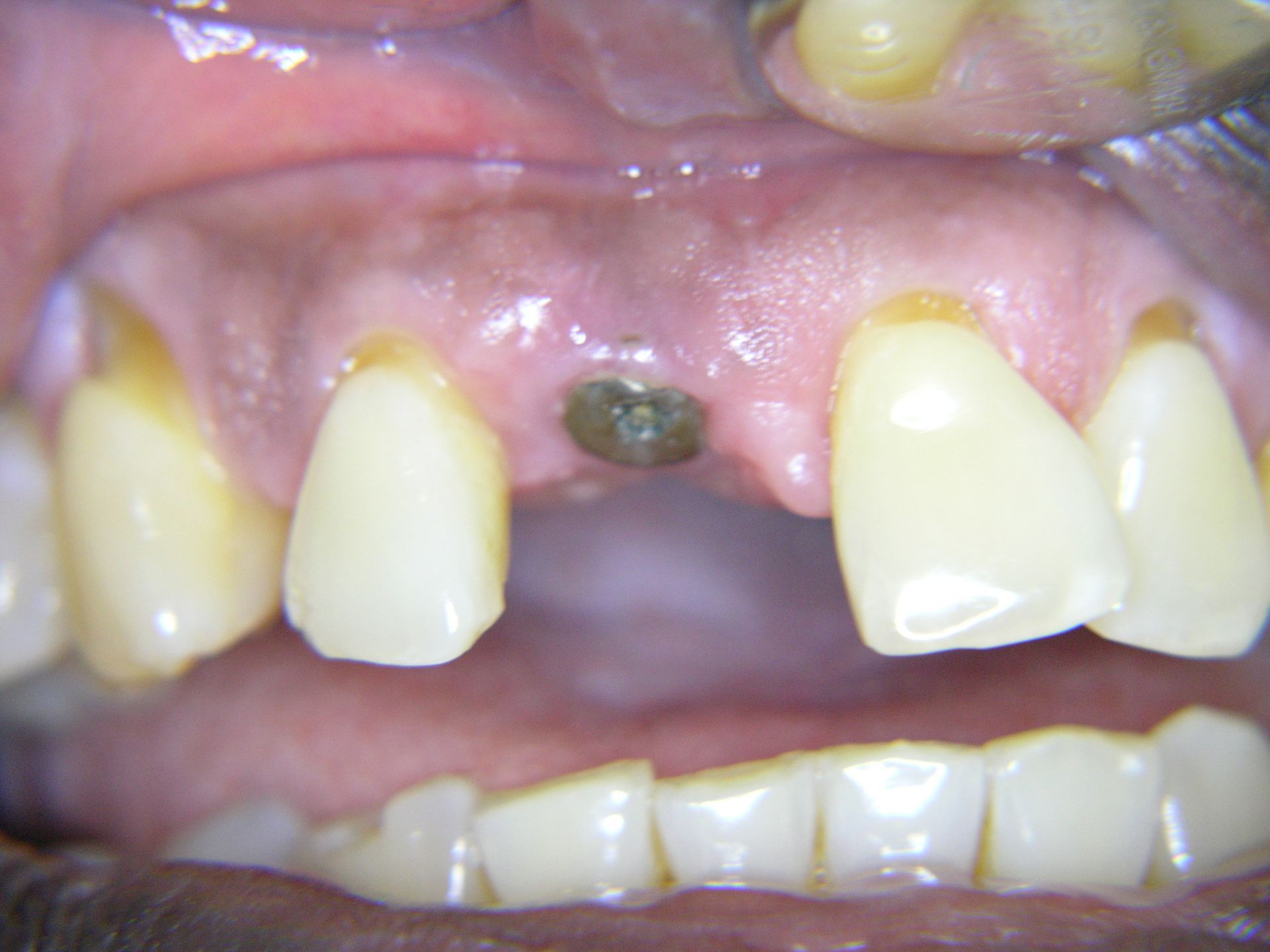 4.Status nach Wiedereröffnung Implantat