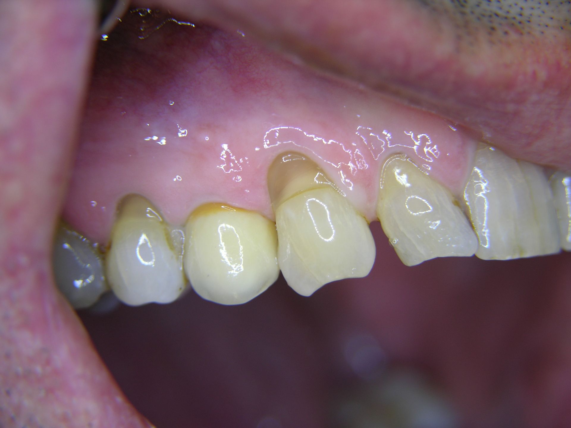 4 Schlussversorgung mit Krone.