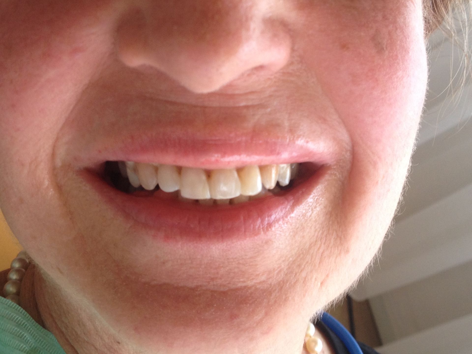 FALL 3 NACH BEHANDLUNG