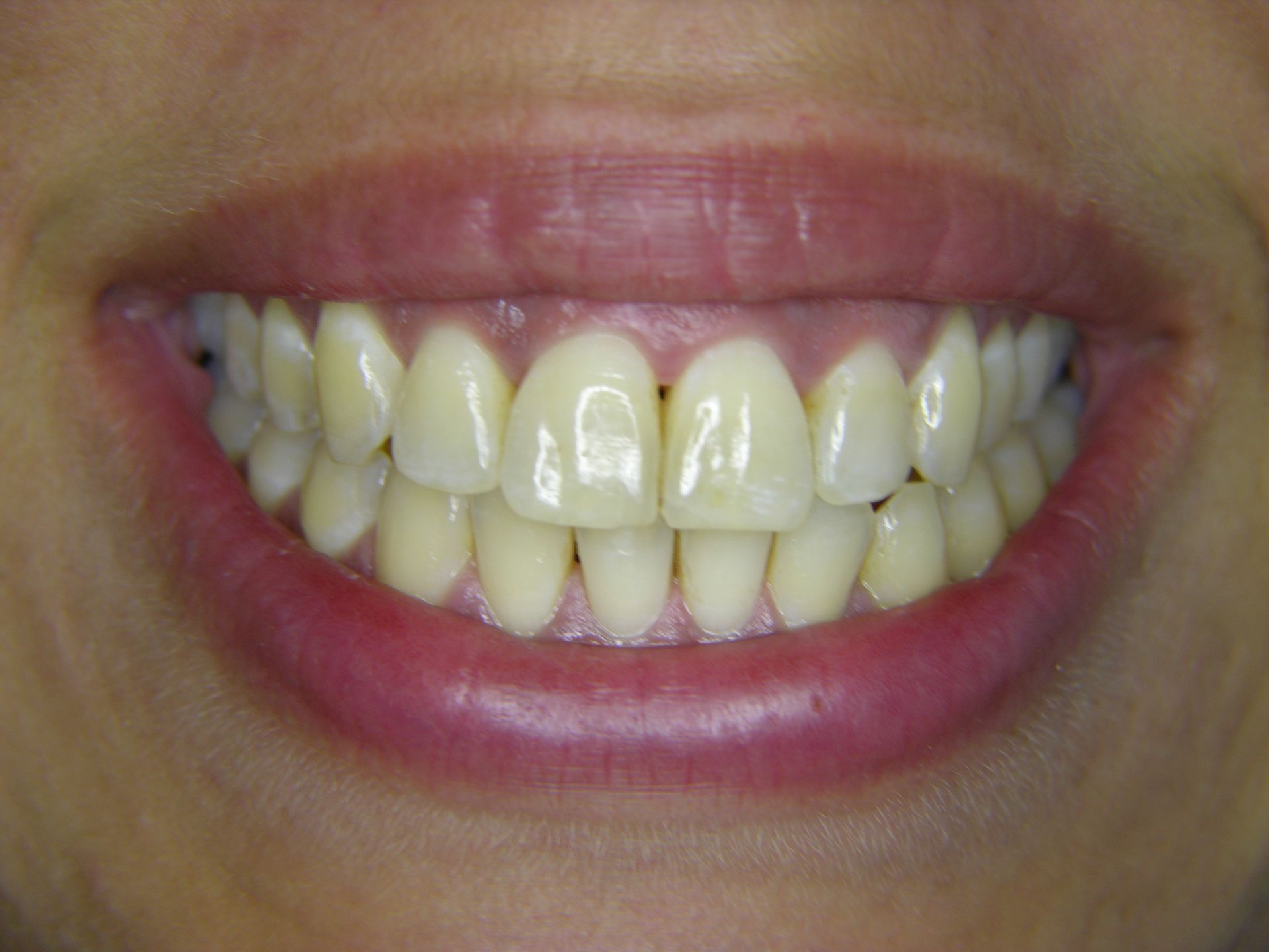 FALL 2 NACH BEHANDLUNG