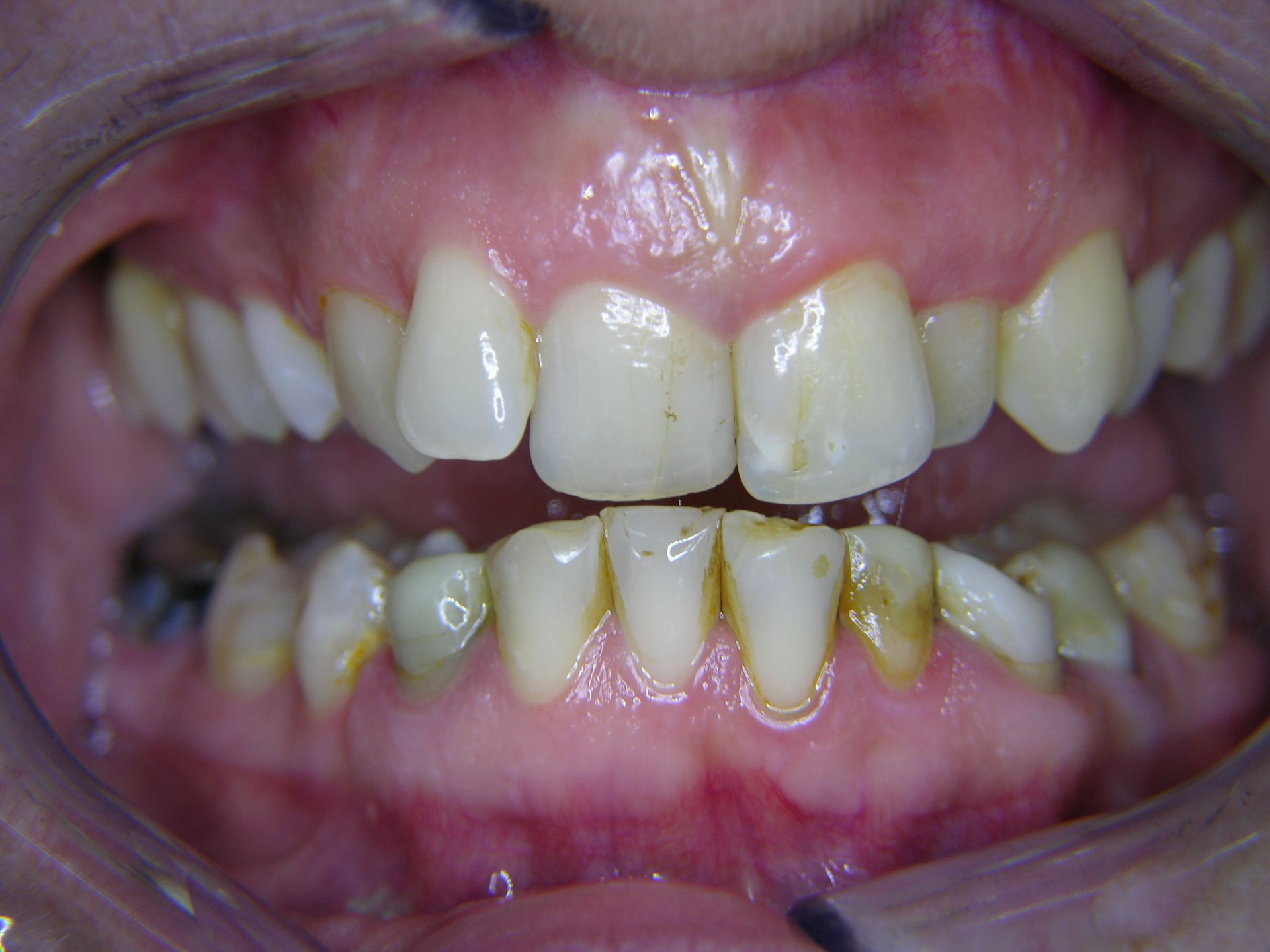 FALL 1 ANFANG BEHANDLUNG