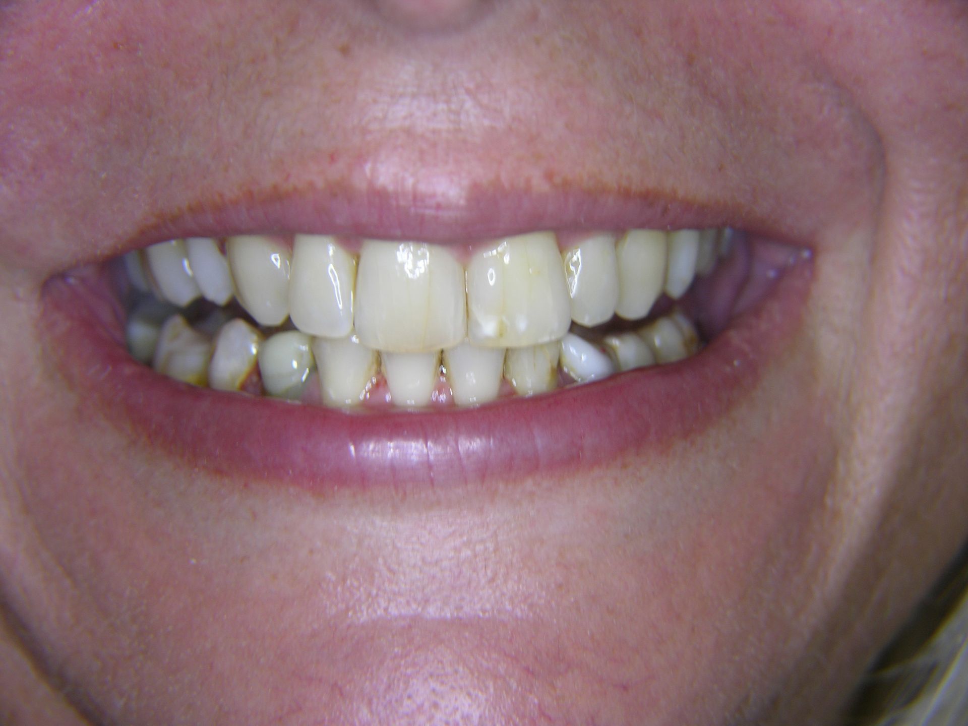 FALL 1 NACH BEHANDLUNG