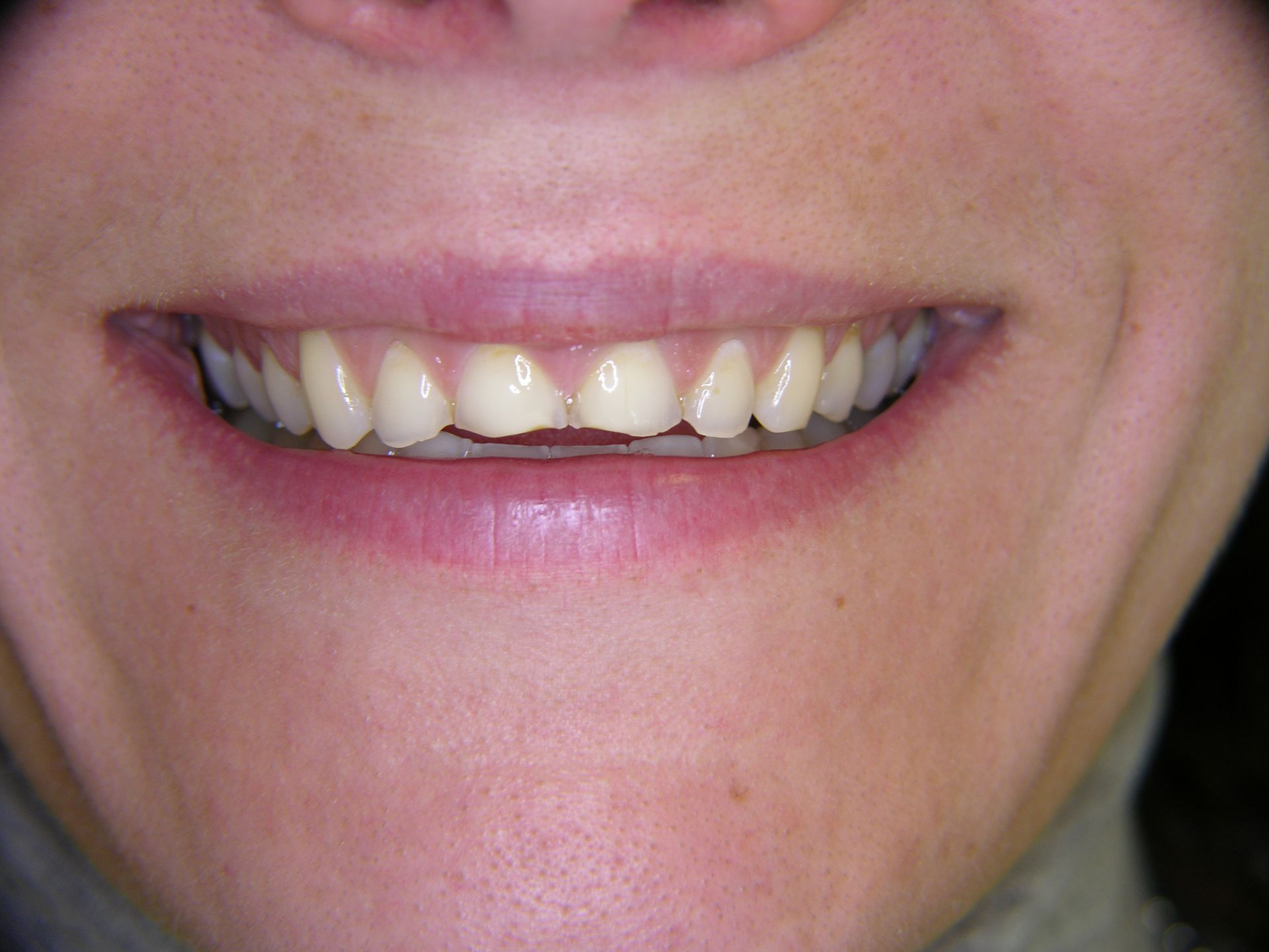 SÄURESCHÄDEN AN FRONTZÄHNEN