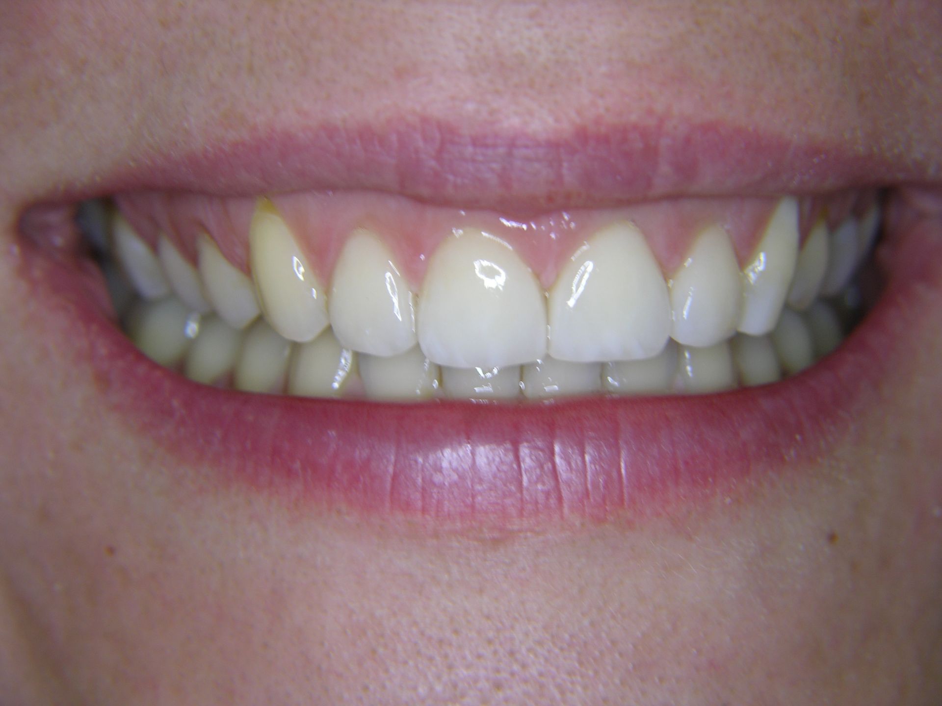 SÄURESCHÄDEN NACH VERSORGUNG