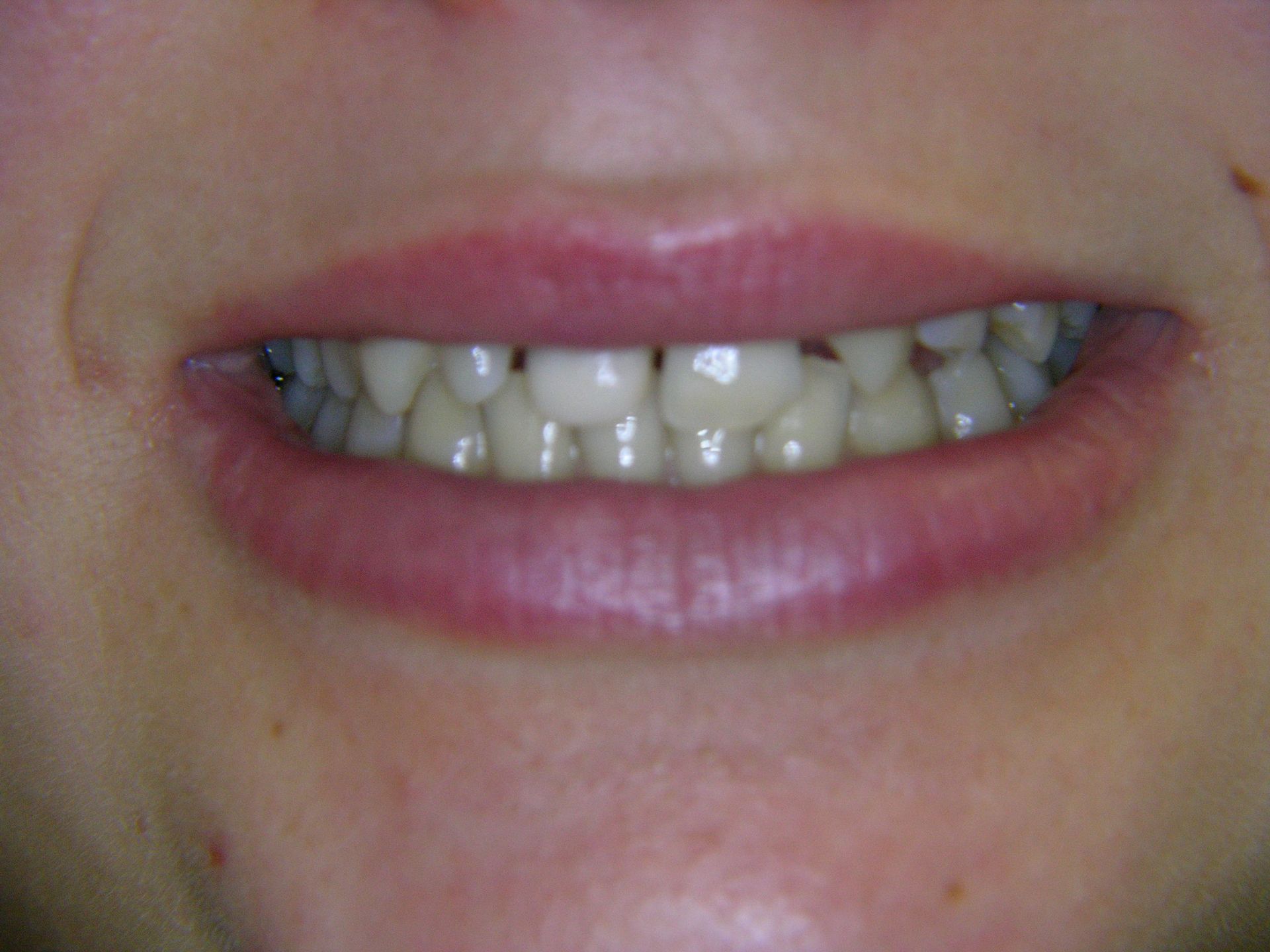 ZAPFENZÄHNE UND NICHTANLAGE ANFANG