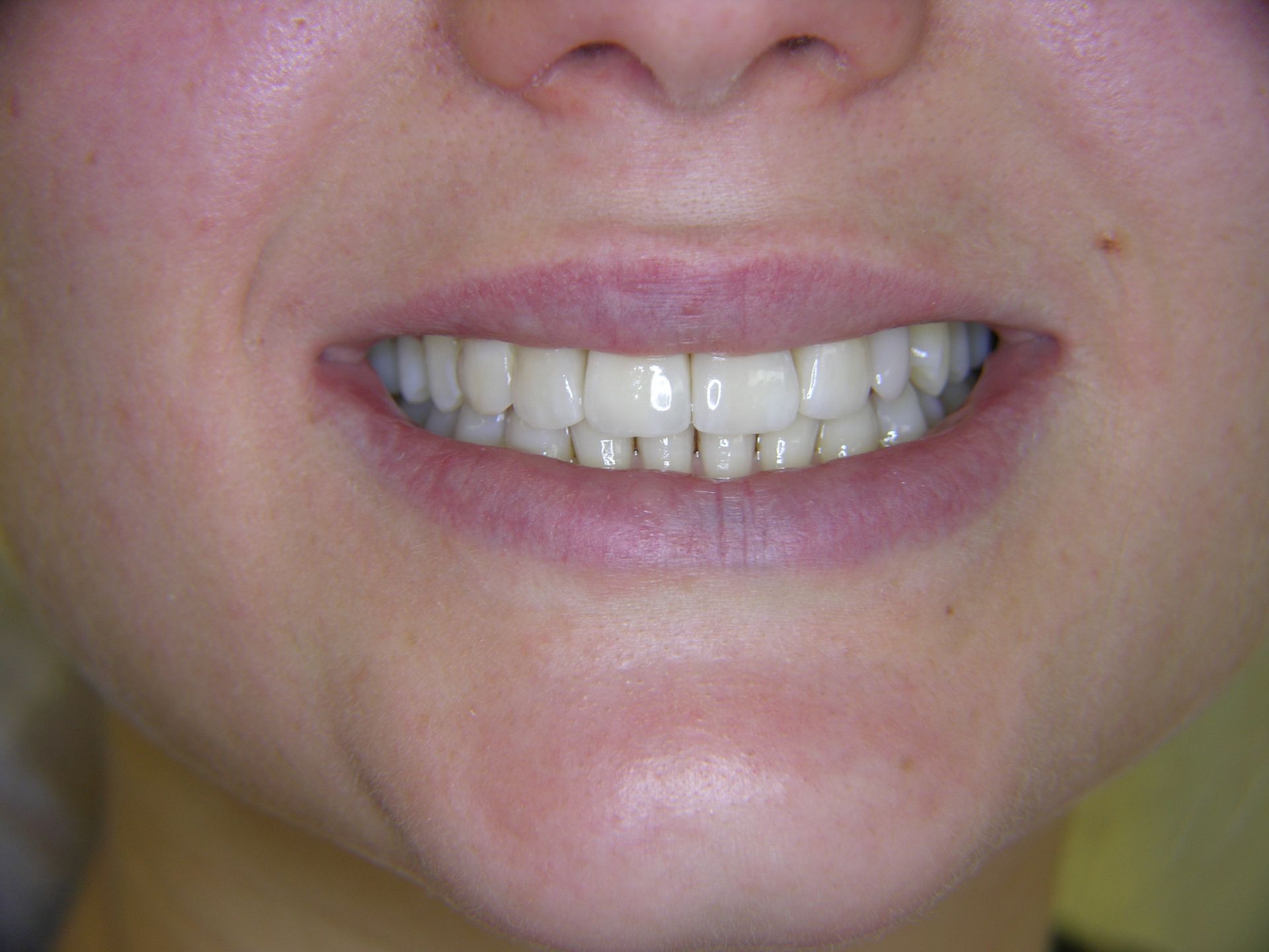 ZAPFENZÄHNE UND NICHTANLAGE NACH VERSORGUNG