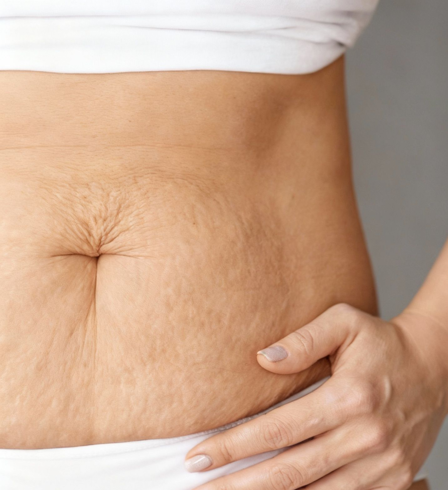 Pancia di donna con smagliature