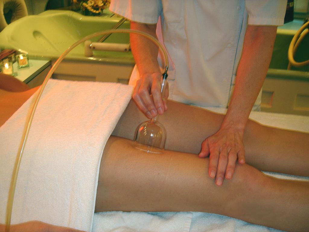 Traitement ventouse chinoise