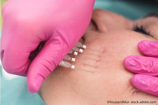 Fadenlifting-Behandlung