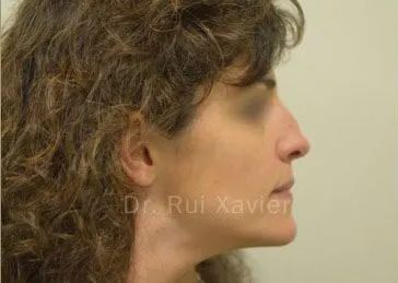 casos clinicos rui xavier rinoplastia