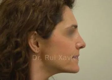 casos clinicos rui xavier rinoplastia