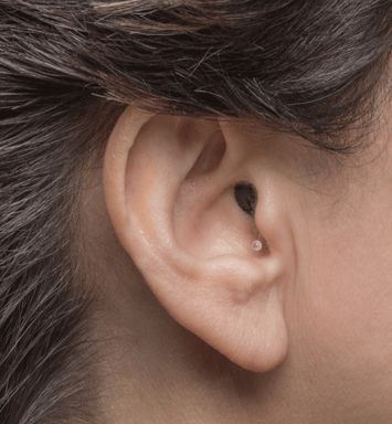 Ακουστικά Βαρηκοΐας ΧΟΛΕΒΑΣ Κ. - ΤΖΗΜΑΣ Γ. Ο.Ε.