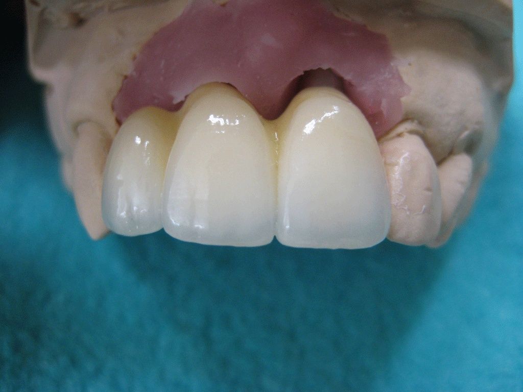 Verblendete Zirkonbrücke - Dentaltechnik G. Stutzer - Altdorf