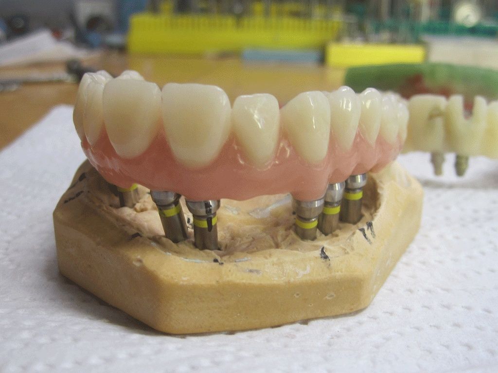 Kunststoff-Implantatbrücke auf Titancadcam-Gerüst - Altdorf