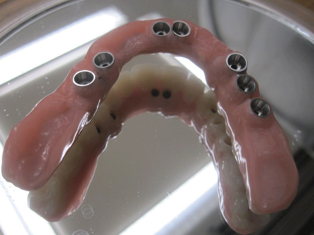 Kunstoffimplantatbrücke - Dentaltechnik G. Stutzer - Altdorf